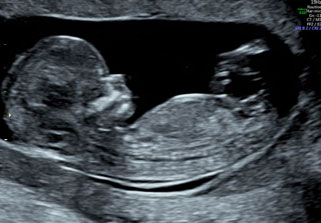 画像：妊娠12週の胎児