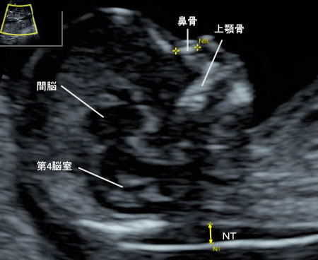 胎児ドック 出生前検査 三重県鈴鹿市の産婦人科 宮崎産婦人科